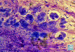 Photo of cytology from ear in (2a): degenerate neutrophils, nuclear streaming, cocci, rods, and intracellular bacteria