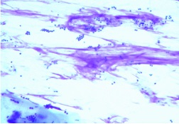 Photo of Cytology showing cocci, nuclear streaming