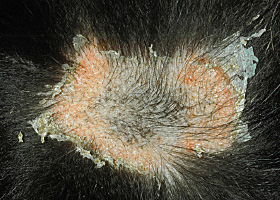 Photo of epidermal collarettes