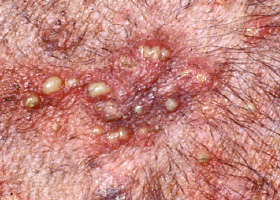 Photo of pustules