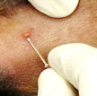 Photo of needle puncturing pustule